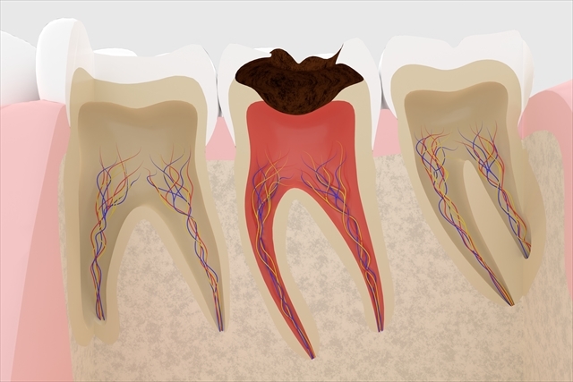子供のむし歯は歯髄炎になりやすい？永久歯の影響も？