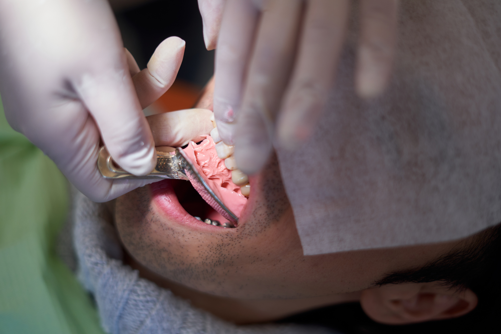 歯科治療で歯型取りが必要な理由