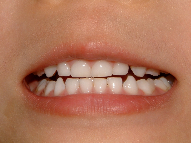 注意すべき子どもの歯並びの異常
