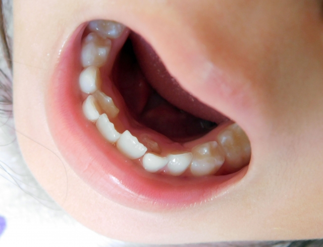 乳歯から永久歯に生え変わる時期について