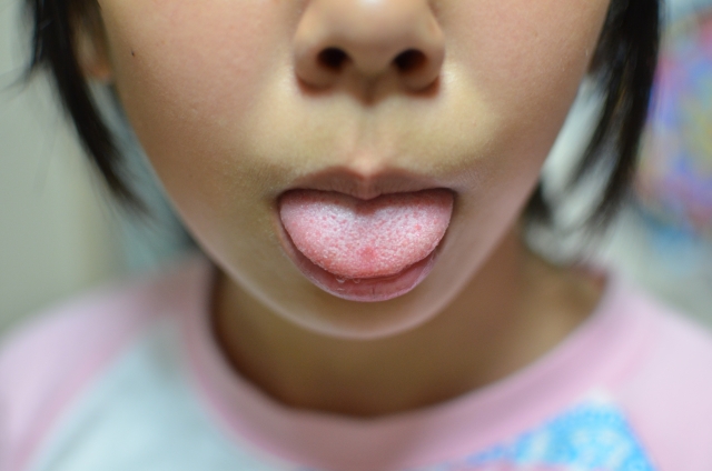 舌癖・指しゃぶりの改善には「タングクリブ」が有効