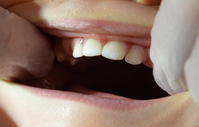 割れると虫歯を引き起こす「中心結節」の対処法