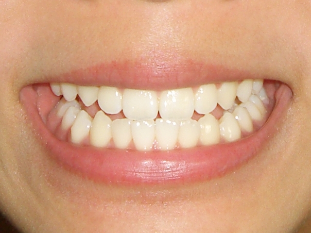 子どもの歯と大人の歯の違いについて