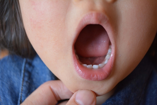 乳歯の虫歯によって生じる永久歯の異常