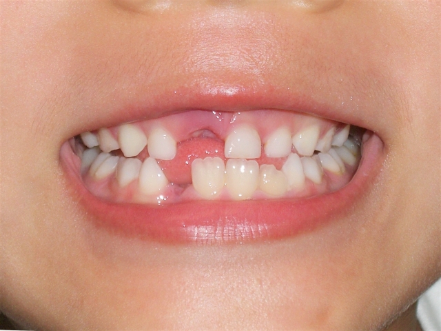 生まれつき歯の少ない先天性欠損歯とは？