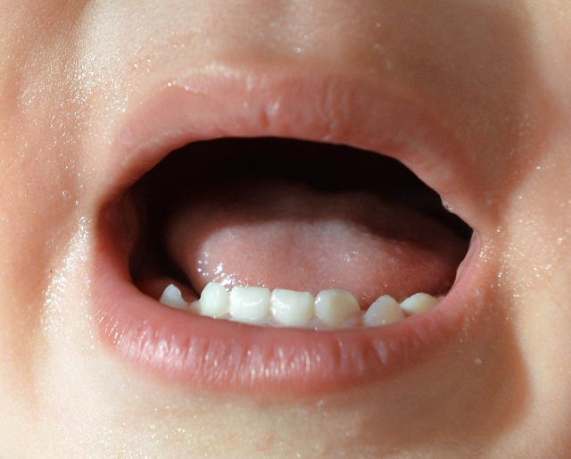 小児矯正が推奨される歯並びの乱れ