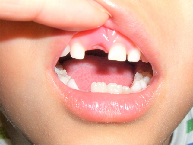 乳歯が早期に脱落した時の対処法