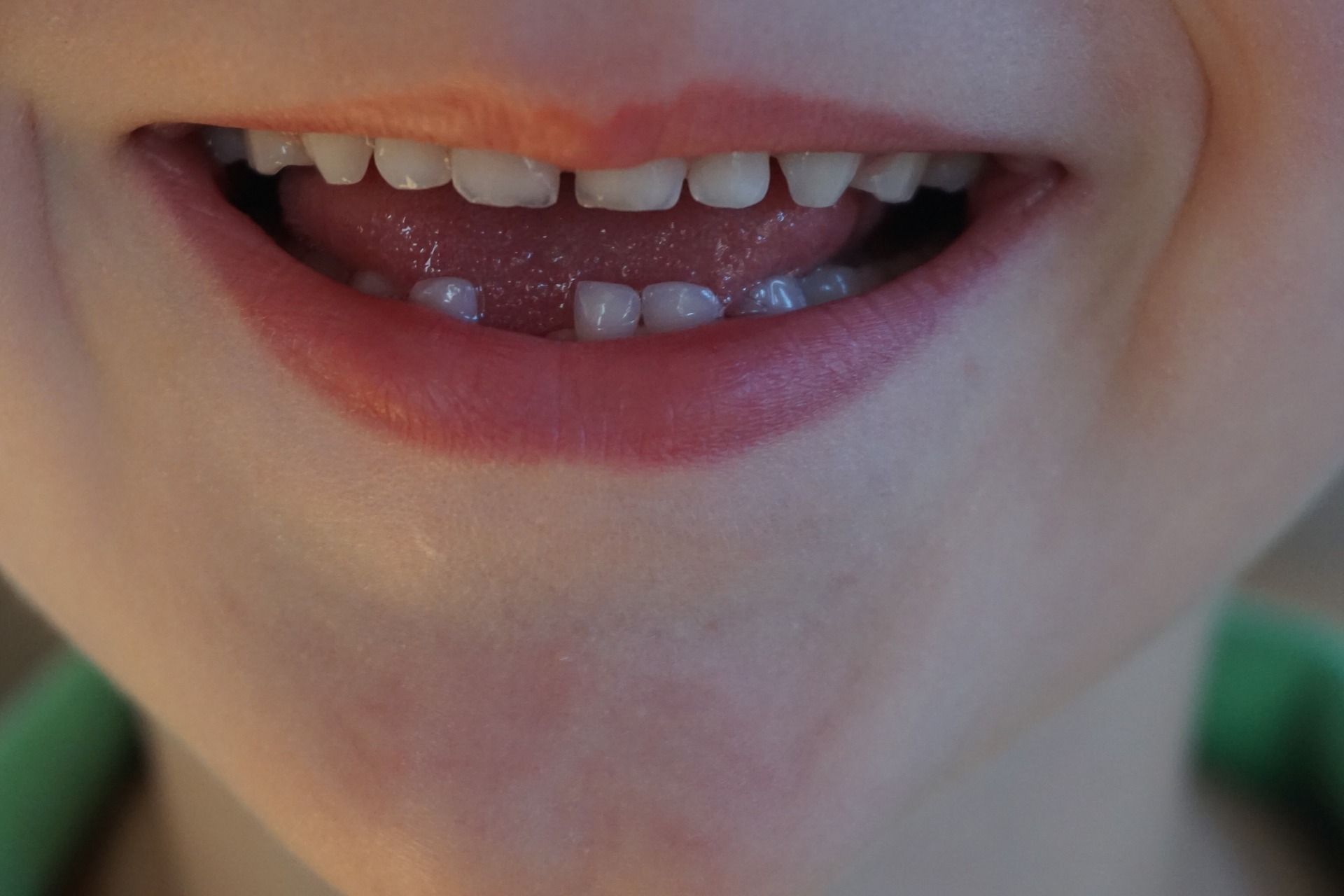 子どもの歯列のすき間について