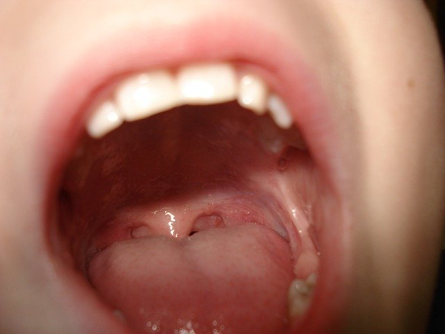 子どもの奥歯はむし歯になりやすい？